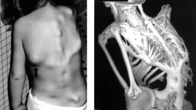 石化綜合征：4 歲患兒全身肌肉變骨頭，11 場手術，越切長得越多