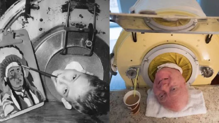 活在罐子裡 70 年，世界上最後一名鐵肺人去世